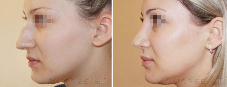 Где можно сделать пластику носа в Корее не дорого?